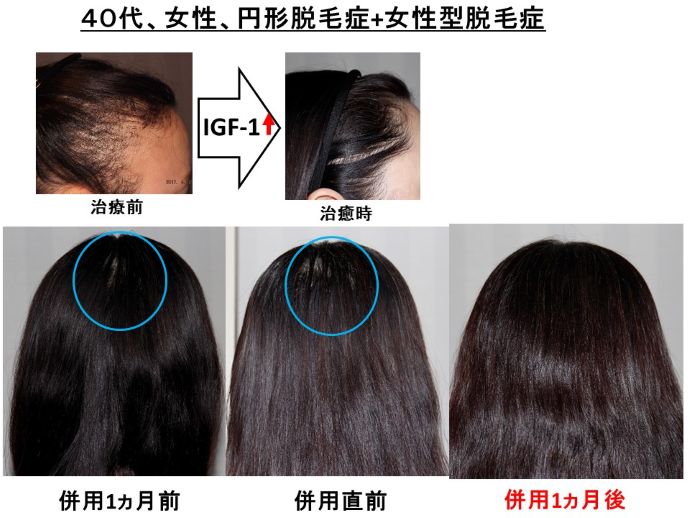 円形脱毛症　病院